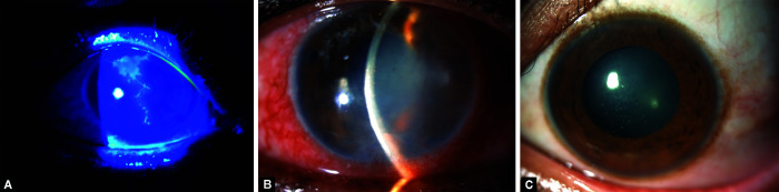 Glaucoma in Viral Keratouveitis: A Retrospective Review at a Tertiary Eye Hospital.