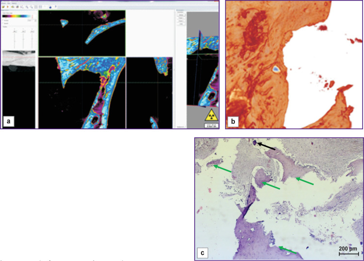 The Comparison of Methods for Bone Reconstruction in the Anterior Wall of the Maxillary Sinus (an Experimental Study).