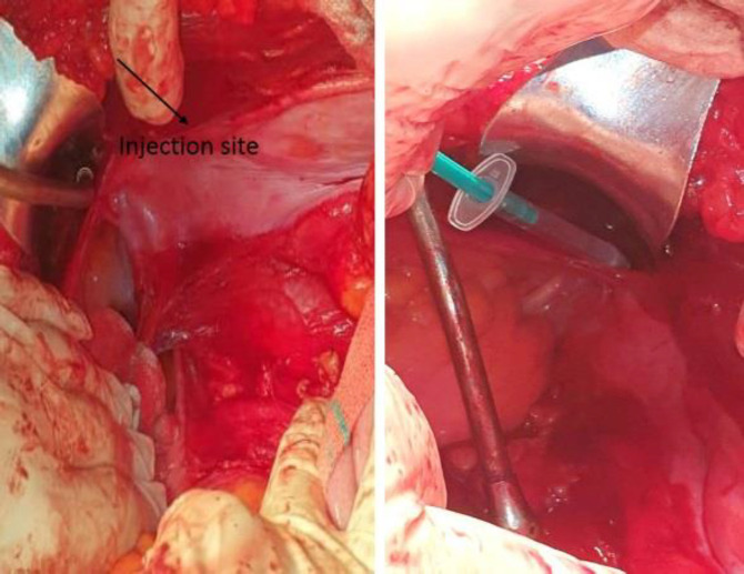 Sentinel lymph node mapping in post chemotherapy nonseminoma testicular cancer patients undergoing retroperitoneal lymph node dissection: A series of nine cases.