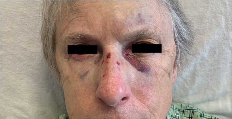 Neurally Mediated Syncope Triggered by COVID-19 Nasopharyngeal Swab Specimen Collection: A Case Report.