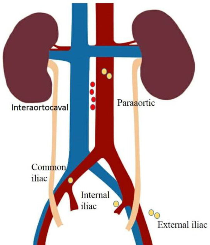 Sentinel lymph node mapping in post chemotherapy nonseminoma testicular cancer patients undergoing retroperitoneal lymph node dissection: A series of nine cases.