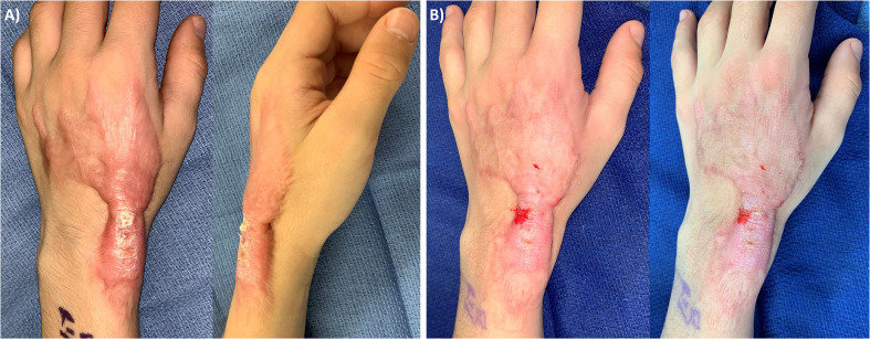 CO<sub>2</sub> laser resurfacing for burn and traumatic scars of the hand and upper extremity.