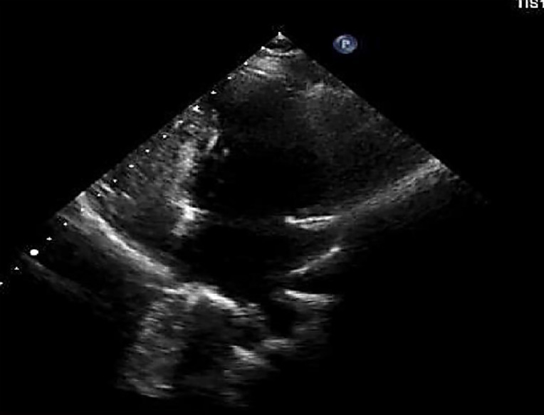 Iatrogenic partial diversion of inferior vena cava to left atrium after surgical closure of atrial septal defect.