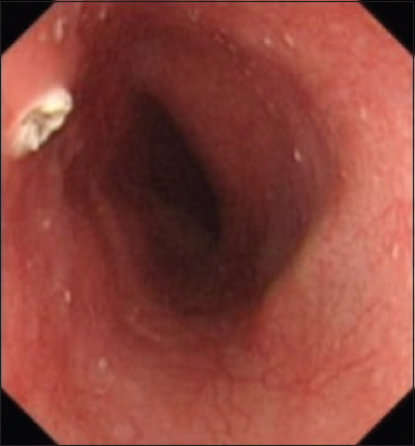 A Case of Esophageal Squamous Papilloma: An Unusual Cause of Dysphagia and Hematemesis in a Patient with Concurrent Malignancies.