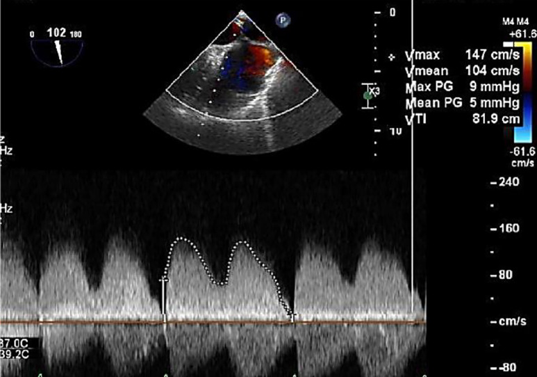 Iatrogenic partial diversion of inferior vena cava to left atrium after surgical closure of atrial septal defect.