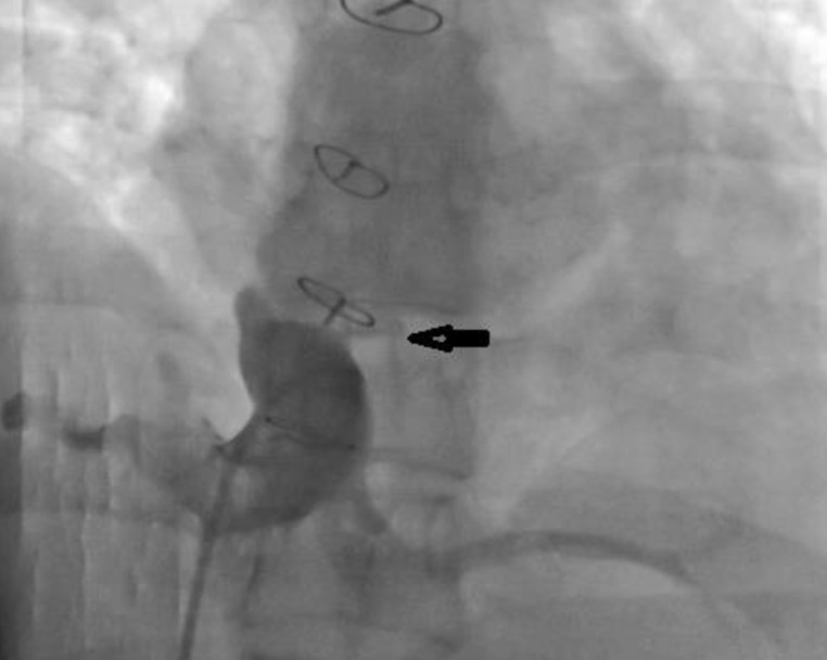 Iatrogenic partial diversion of inferior vena cava to left atrium after surgical closure of atrial septal defect.