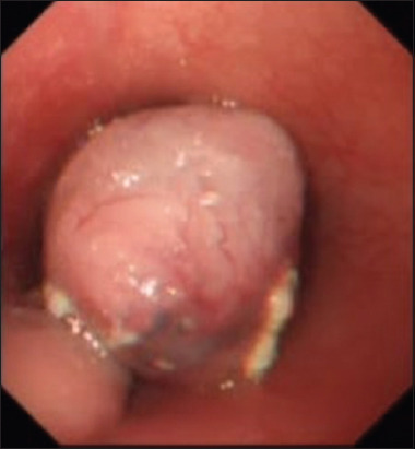 A Case of Esophageal Squamous Papilloma: An Unusual Cause of Dysphagia and Hematemesis in a Patient with Concurrent Malignancies.