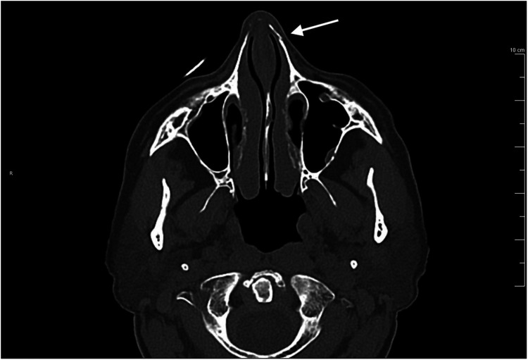 Neurally Mediated Syncope Triggered by COVID-19 Nasopharyngeal Swab Specimen Collection: A Case Report.