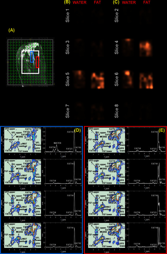 Correlated MR spectroscopic imaging of breast cancer to investigate metabolites and lipids: acceleration and compressed sensing reconstruction.