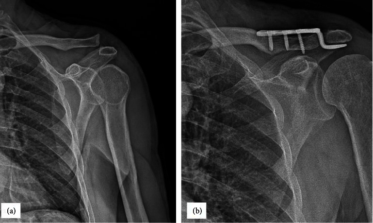 Comparison of the Hook Plate versus TightRope System in the Treatment of Acute Type III Acromioclavicular Dislocation.