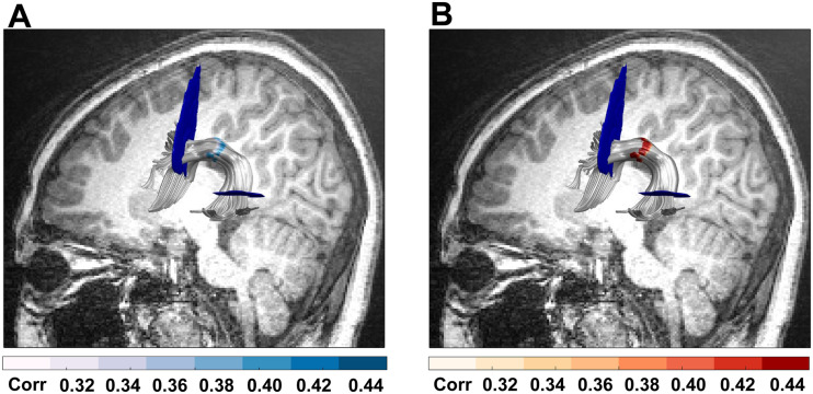 Left and Right Arcuate Fasciculi Are Uniquely Related to Word Reading Skills in Chinese-English Bilingual Children.