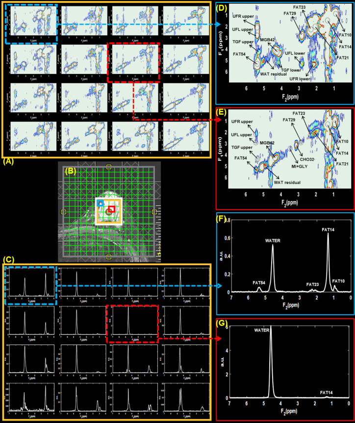 Correlated MR spectroscopic imaging of breast cancer to investigate metabolites and lipids: acceleration and compressed sensing reconstruction.