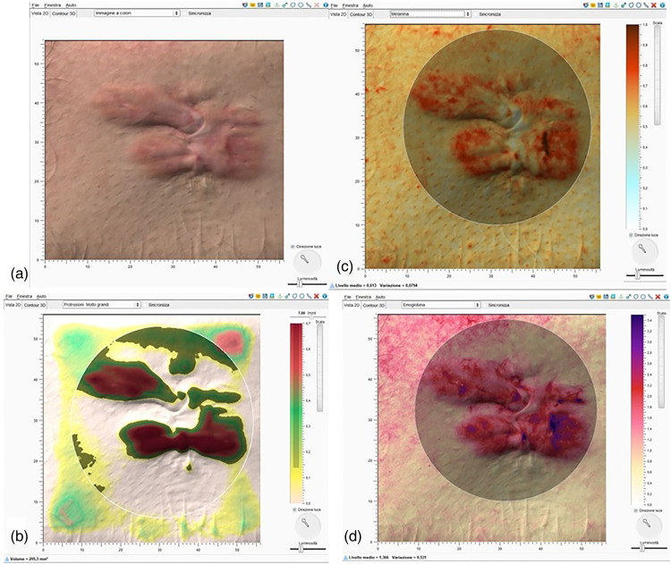 The objective evaluation of triamcinolone acetonide efficacy in keloids management using Antera3D® imaging system.