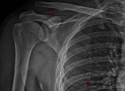 Comparison of the Hook Plate versus TightRope System in the Treatment of Acute Type III Acromioclavicular Dislocation.