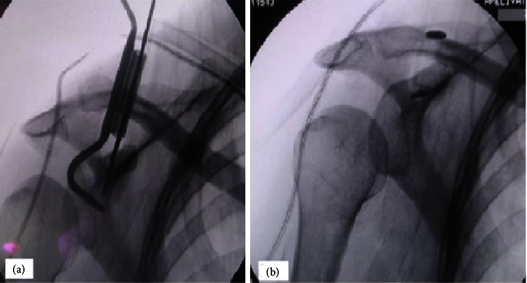 Comparison of the Hook Plate versus TightRope System in the Treatment of Acute Type III Acromioclavicular Dislocation.