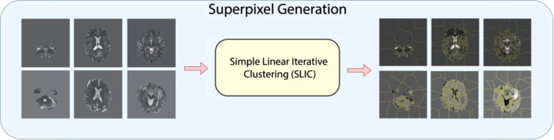 Relevance maps: A weakly supervised segmentation method for 3D brain tumours in MRIs.