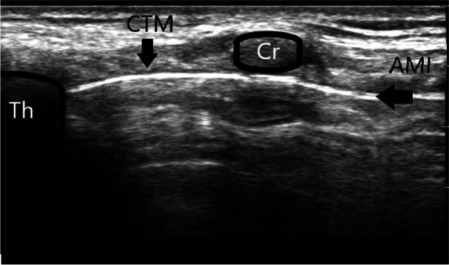 Point-of-Care Ultrasound for the Trauma Anesthesiologist.