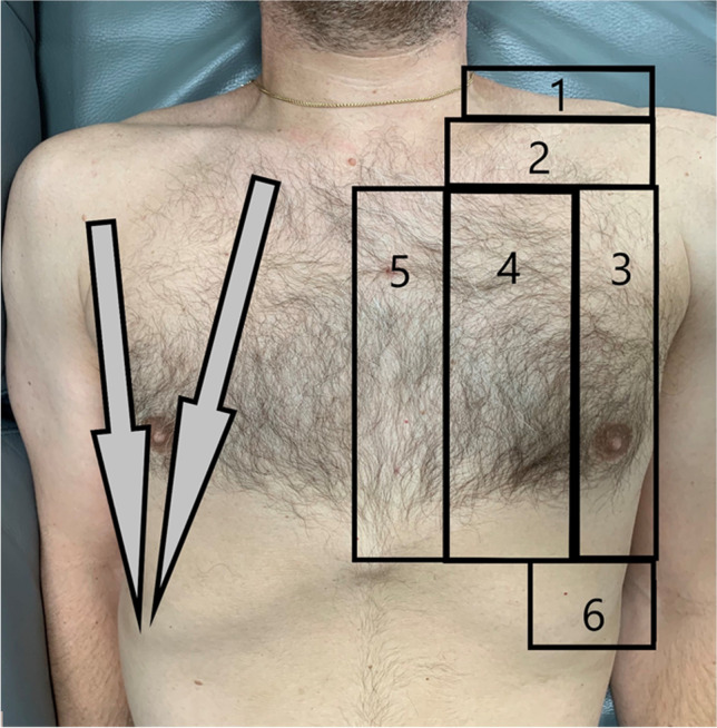 Point-of-Care Ultrasound for the Trauma Anesthesiologist.