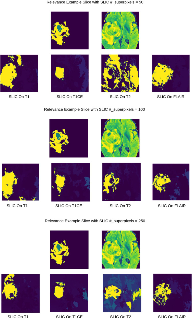 Relevance maps: A weakly supervised segmentation method for 3D brain tumours in MRIs.