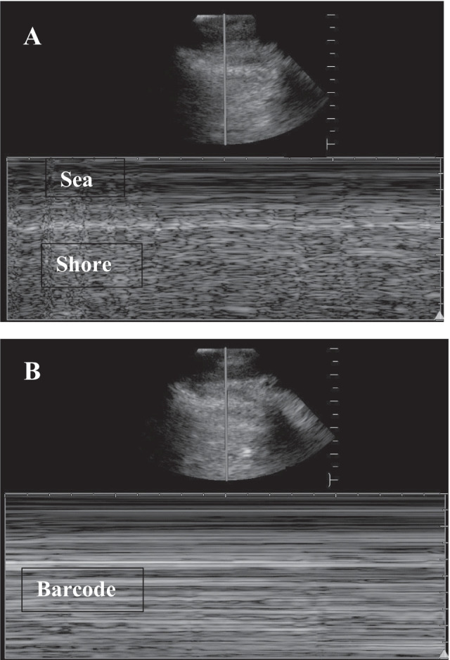 Point-of-Care Ultrasound for the Trauma Anesthesiologist.