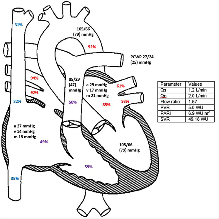 A Case of Complex Pulmonary Hypertension: the Importance of Diagnostic Investigation.