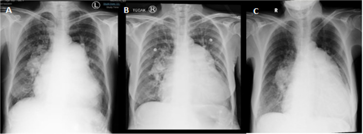 A Case of Complex Pulmonary Hypertension: the Importance of Diagnostic Investigation.