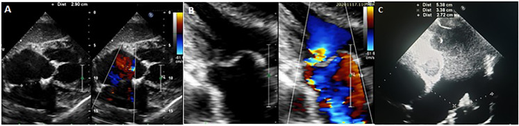 A Case of Complex Pulmonary Hypertension: the Importance of Diagnostic Investigation.