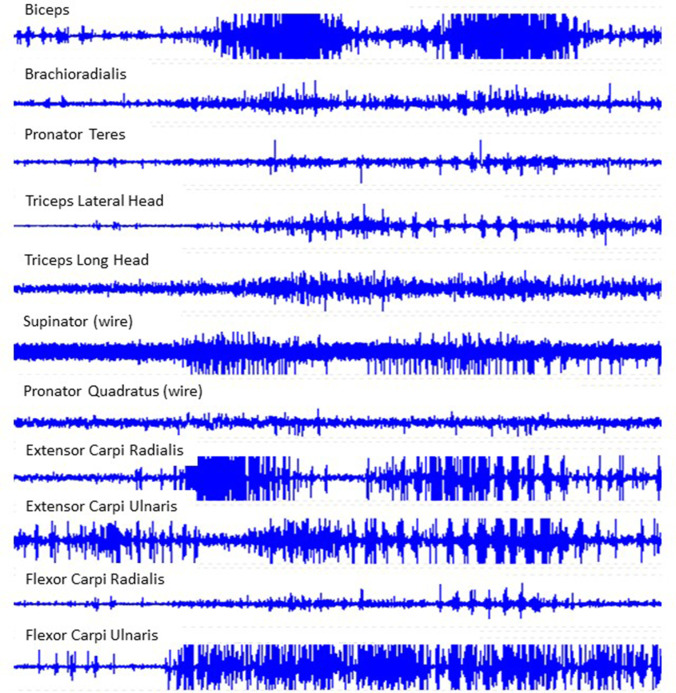 Disorders of Movement due to Acquired and Traumatic Brain Injury.