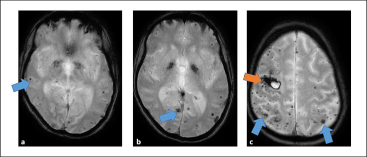 Cerebral Amyloid Angiopathy with Lobar Haemorrhages and CAA-Related Inflammation in an Indian Family.