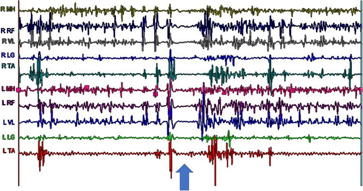 Disorders of Movement due to Acquired and Traumatic Brain Injury.