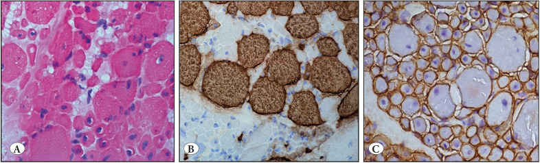 The Histopathologic Examination of a Second Muscle Biopsy Specimen at a Later Date may Sometimes be the Best Approach to Make a Differential Diagnosis in Neuromuscular Disorders.