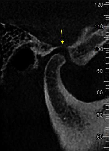 Evaluation of Superior Semicircular Canal Morphology and Its Relationship with Glenoid Fossa Roof Thickness Using Cone Beam Computed Tomography.