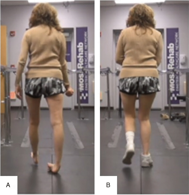 Disorders of Movement due to Acquired and Traumatic Brain Injury.