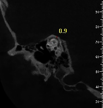 Evaluation of Superior Semicircular Canal Morphology and Its Relationship with Glenoid Fossa Roof Thickness Using Cone Beam Computed Tomography.