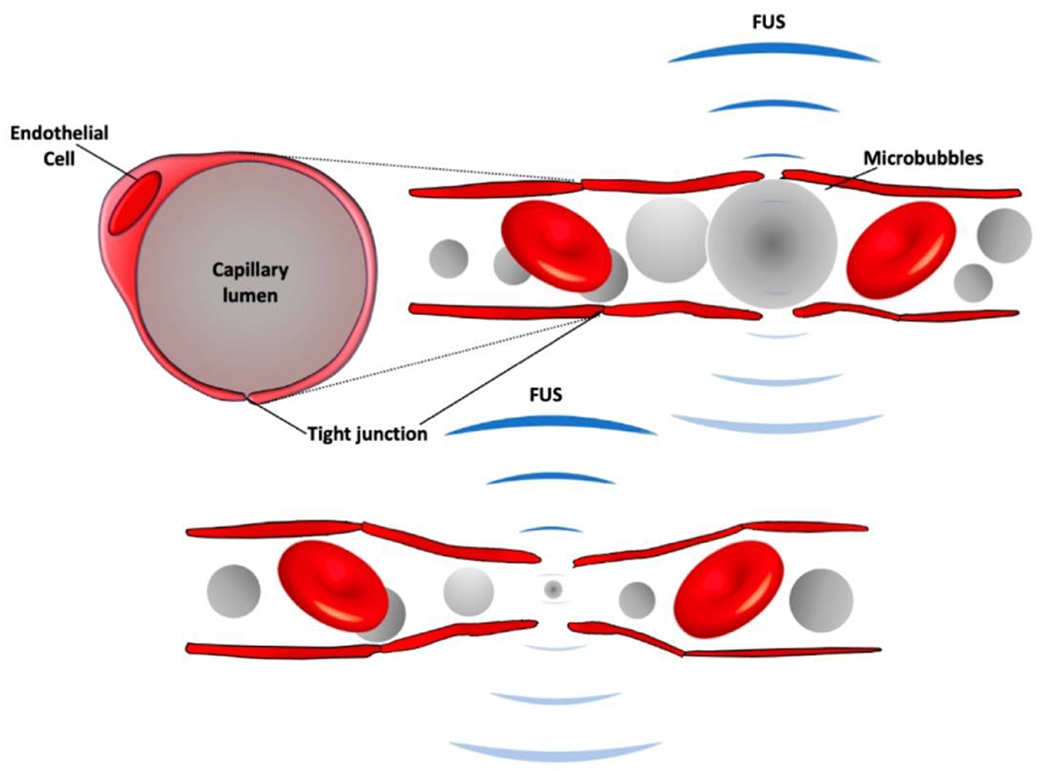 Endovascular Chemotherapy: Selective Targeting for Brain Cancer.