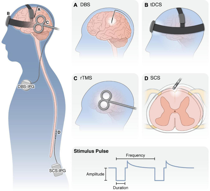 The role of endogenous opioid neuropeptides in neurostimulation-driven analgesia.