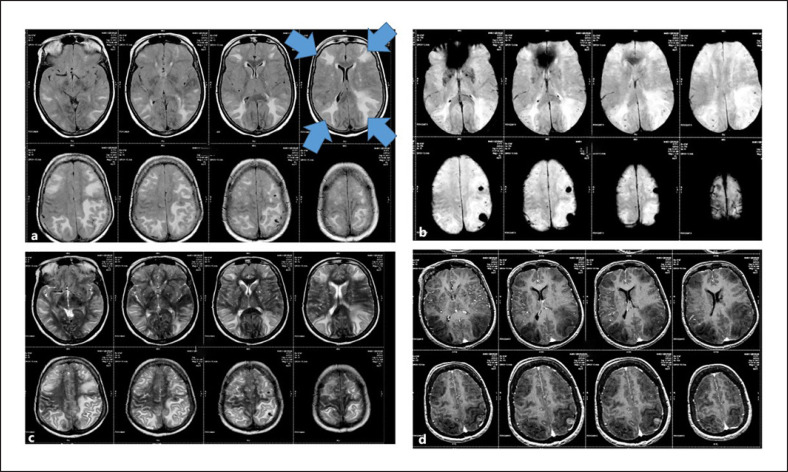 Cerebral Amyloid Angiopathy with Lobar Haemorrhages and CAA-Related Inflammation in an Indian Family.