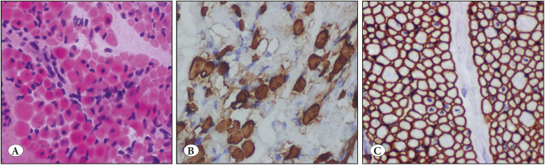 The Histopathologic Examination of a Second Muscle Biopsy Specimen at a Later Date may Sometimes be the Best Approach to Make a Differential Diagnosis in Neuromuscular Disorders.