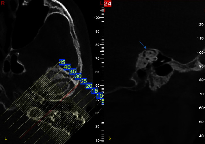 Evaluation of Superior Semicircular Canal Morphology and Its Relationship with Glenoid Fossa Roof Thickness Using Cone Beam Computed Tomography.