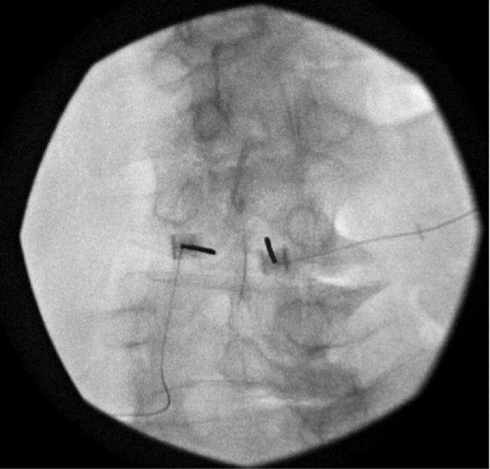 Lumbar Level Peripheral Nerve Stimulation for Low Back Pain.