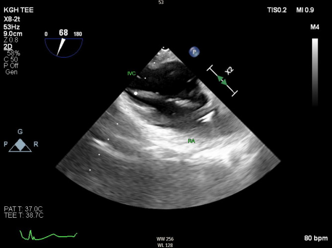 Transesophageal Echocardiography Guided Partial Right Atrial Inflow Occlusion - A Case Study.