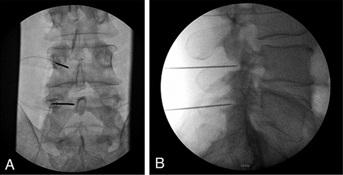 Lumbar Level Peripheral Nerve Stimulation for Low Back Pain.