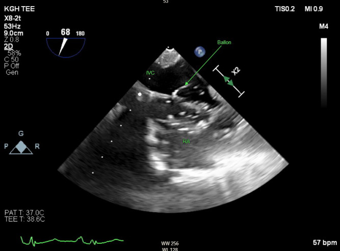 Transesophageal Echocardiography Guided Partial Right Atrial Inflow Occlusion - A Case Study.