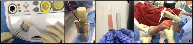 Evolution of a concept with enzymatic debridement and autologous in situ cell and platelet-rich fibrin therapy (BroKerF).