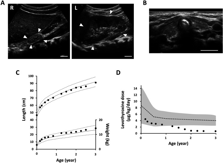 A patient with congenital hypothyroidism due to a <i>PAX8</i> frameshift variant accompanying a urogenital malformation.