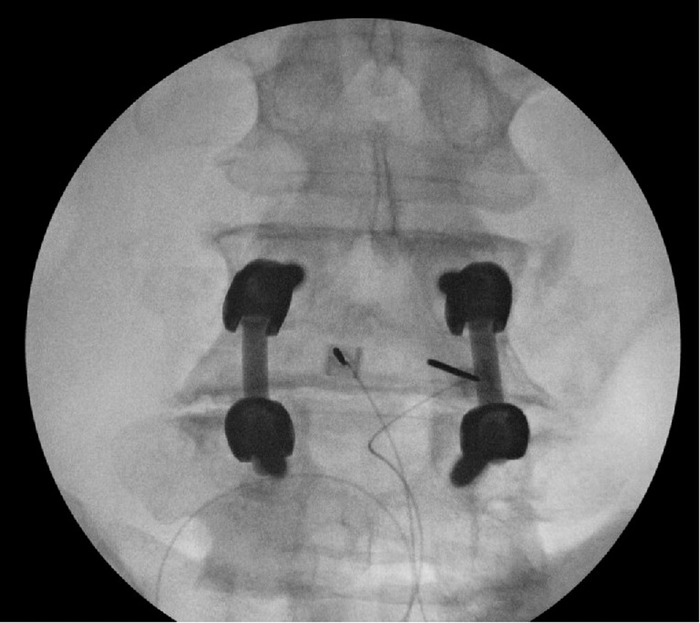 Lumbar Level Peripheral Nerve Stimulation for Low Back Pain.