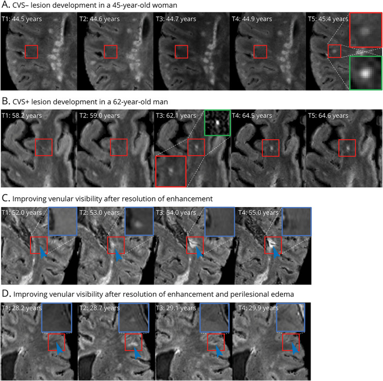 Central Vein Sign Profile of Newly Developing Lesions in Multiple Sclerosis: A 3-Year Longitudinal Study.