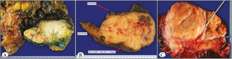 Mesenchymal Tumors Involving the Pancreas: A Clinicopathologic Analysis and Review of the Literature.