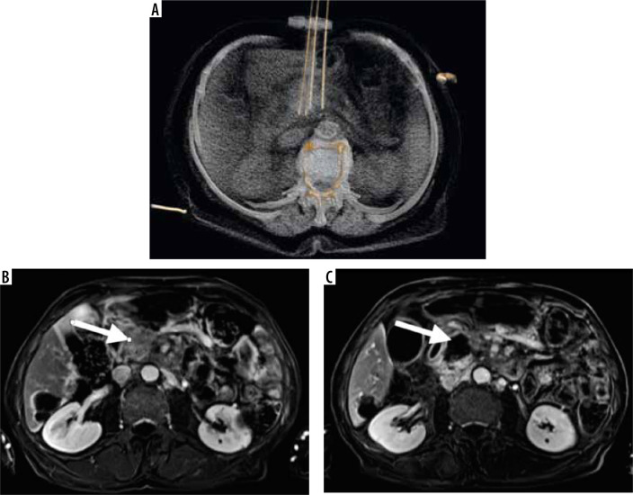 Benefitial role of electrochemotherapy in locally advanced pancreatic cancer - radiological perspective.