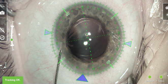 [Unilateral implantation of a new extended range of vision intraocular lens in a young patient].